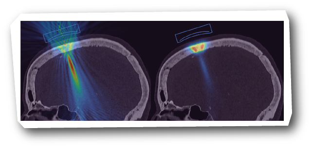 Transcranial Ultrasound Stimulation (TUS)/Transcranial Focused ...